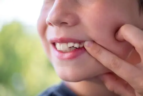 Crooked Teeth Treatment