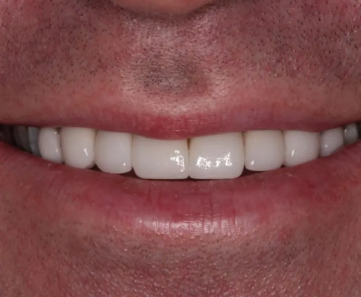 Completion of Porcelain Veneers Kai Dental Queensway