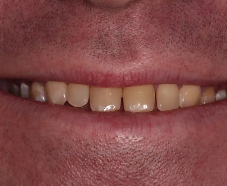 Before Porcelain Veneers Kai Dental