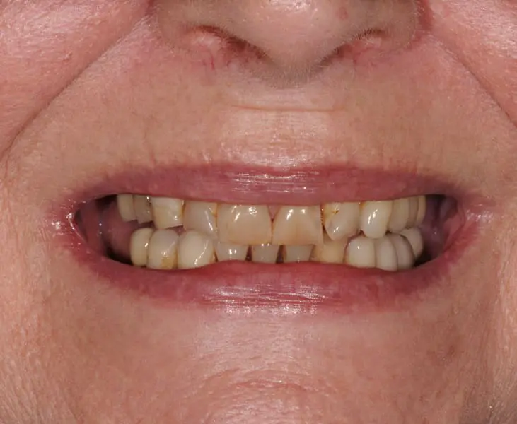 Porcelain Venneers Before Kai Dental Queensway