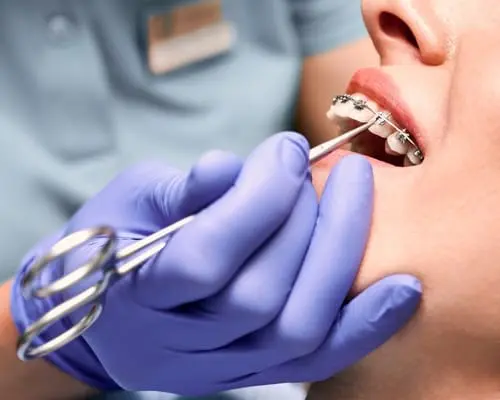 Metal Braces London