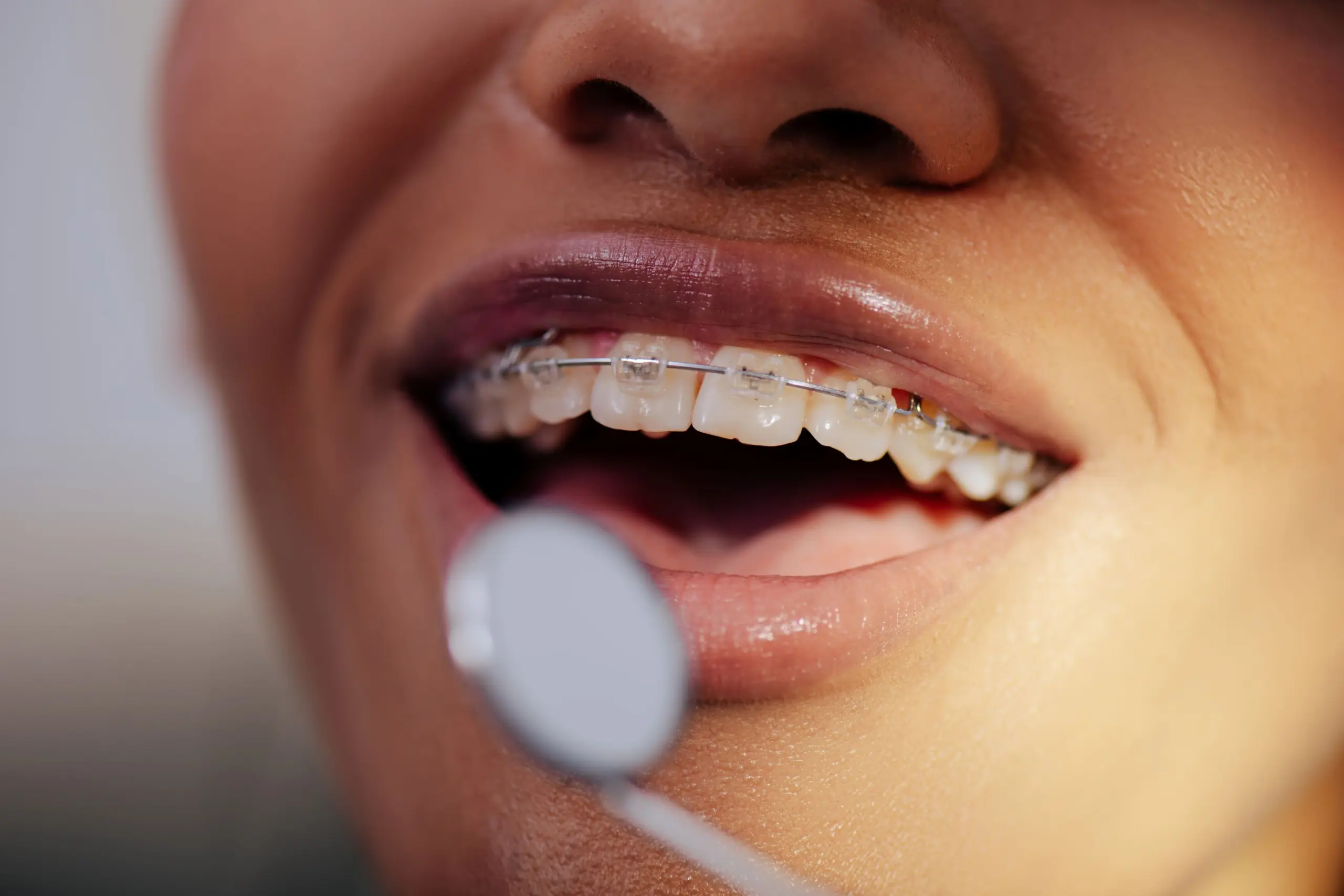 Showing woman in dentist getting fixed braces