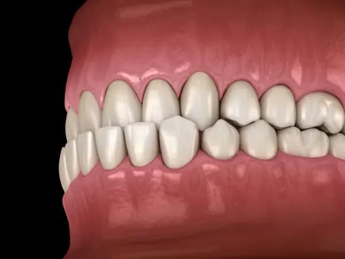 Underbite Treatment