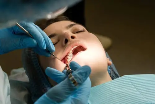 Wisdom Teeth Removal London