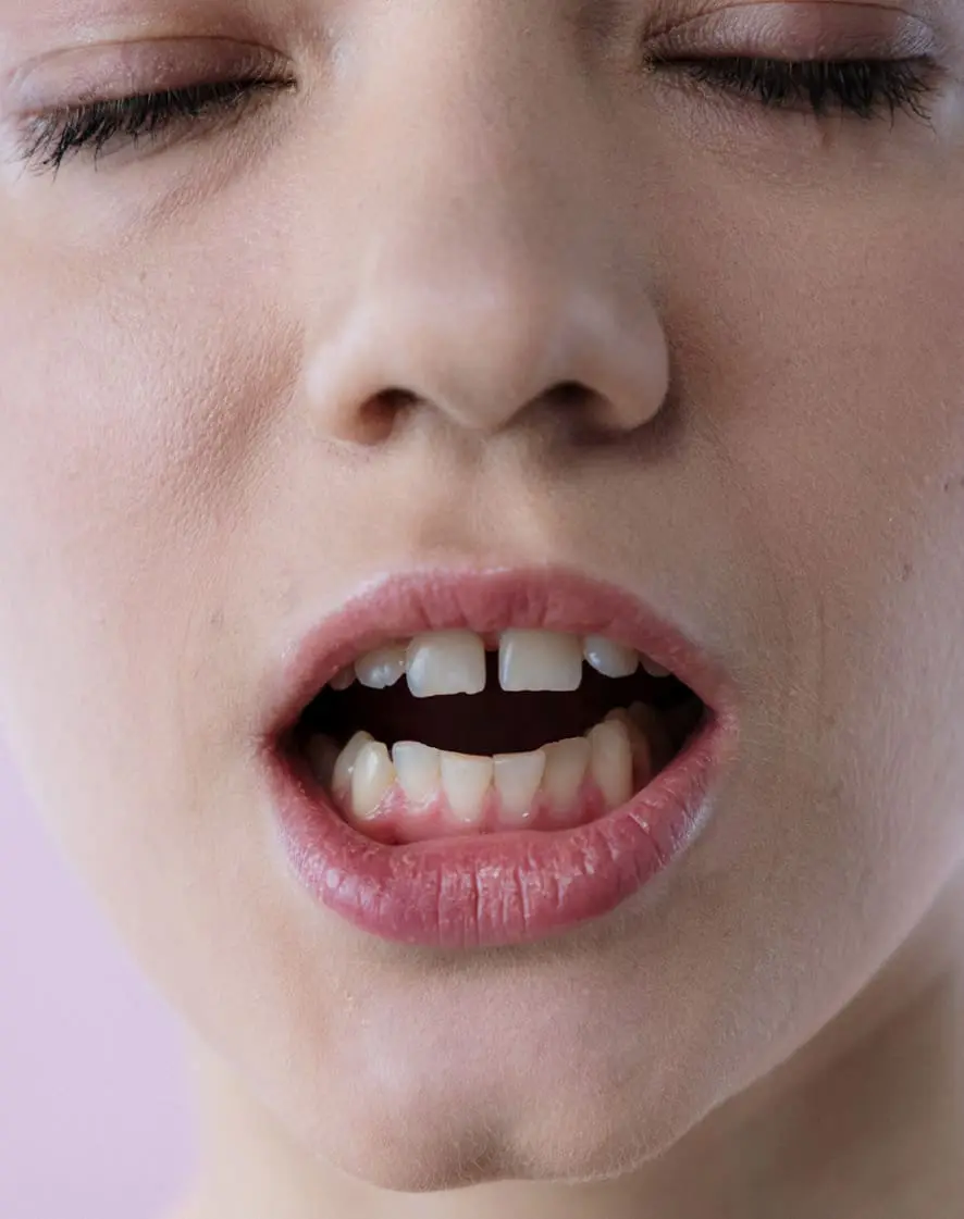 Gappy Teeth