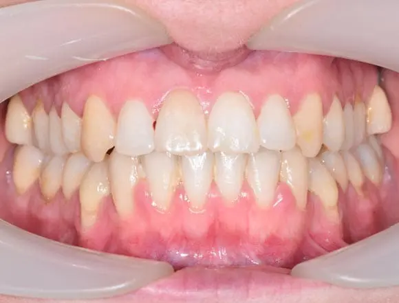 Ceramic Braces