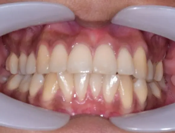 Ceramic Braces