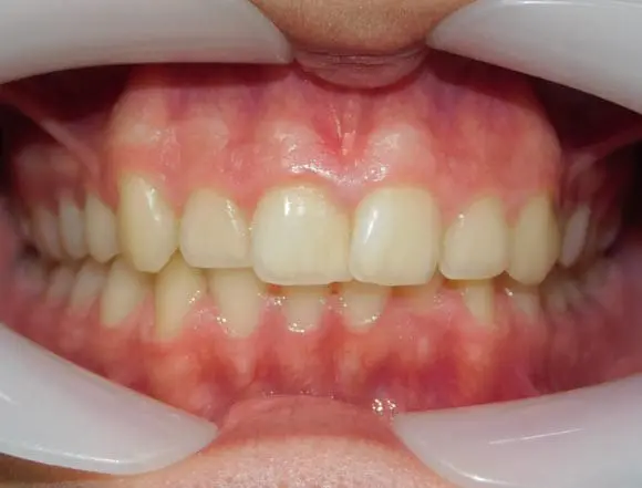 Ceramic Braces