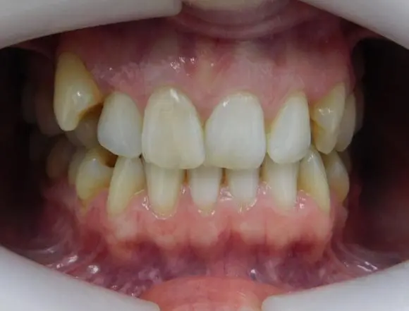 Ceramic Braces