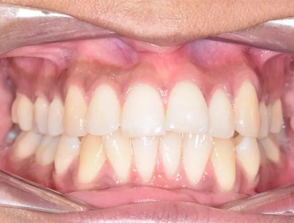 Ceramic Braces