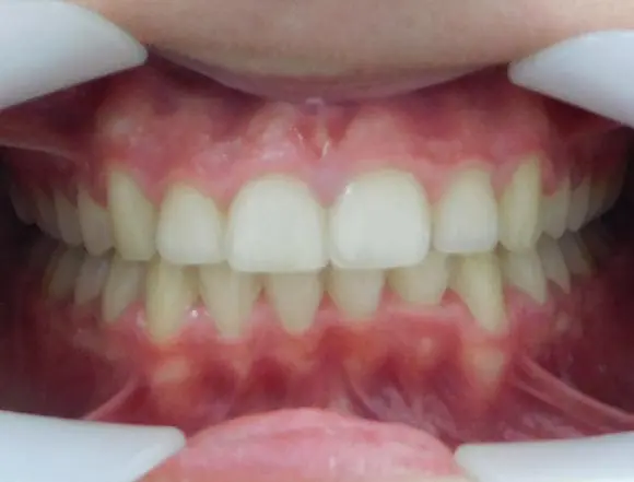 Ceramic Braces
