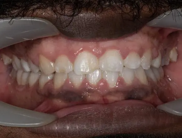Composite Bonding