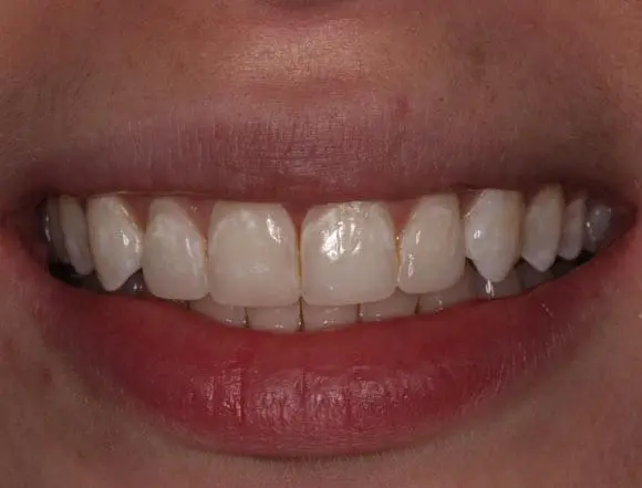 Composite Bonding