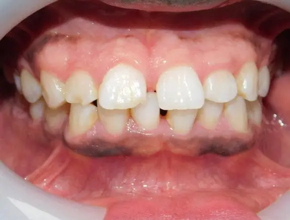 Composite Bonding