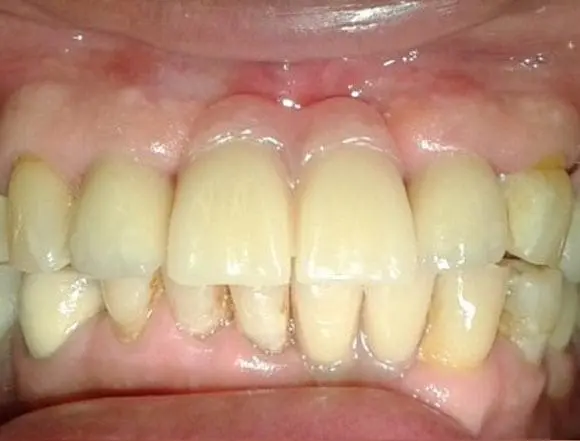 Dentures