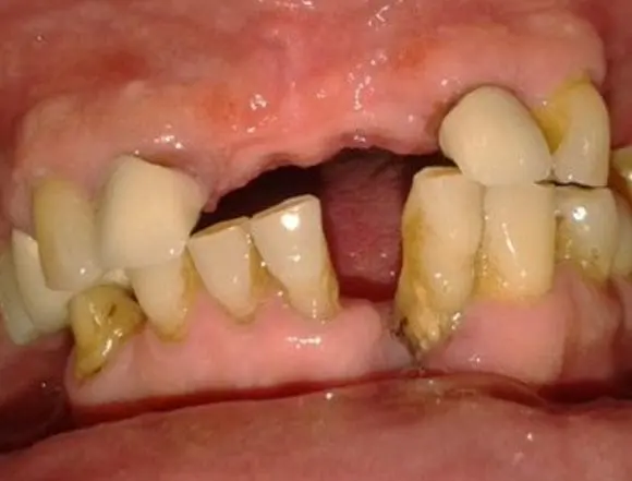 Dentures