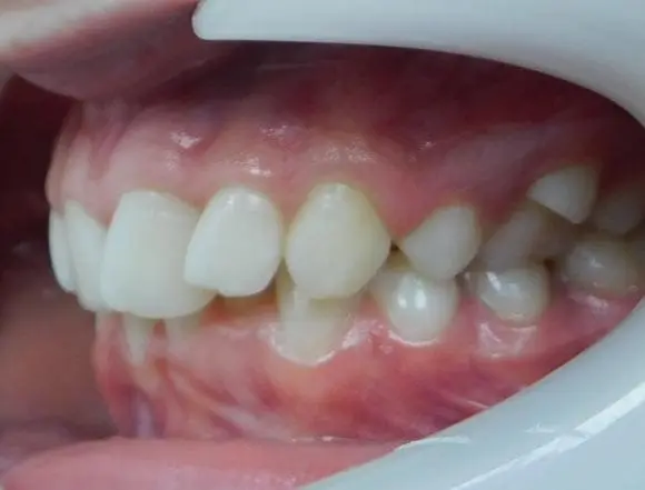 Fixed Braces