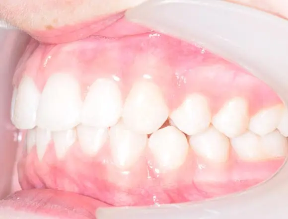 Fixed Braces