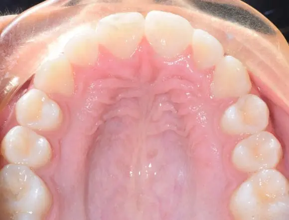 Fixed Braces