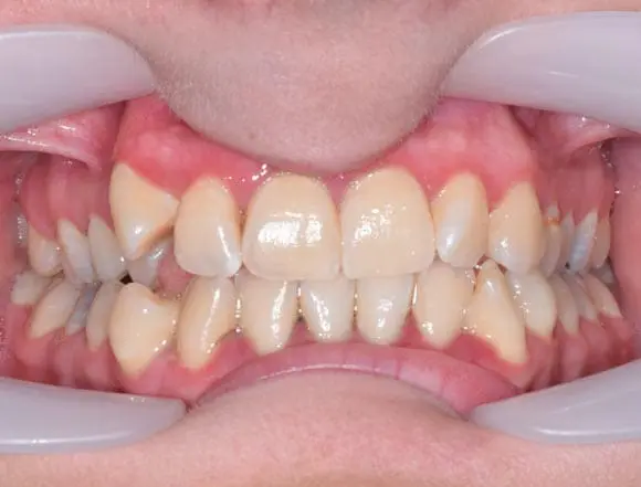 Fixed Ceramic Braces