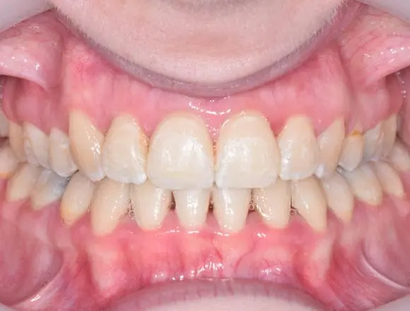 Fixed Ceramic Braces