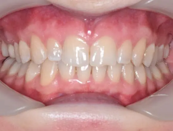 Invisalign