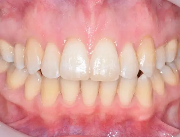 Invisalign