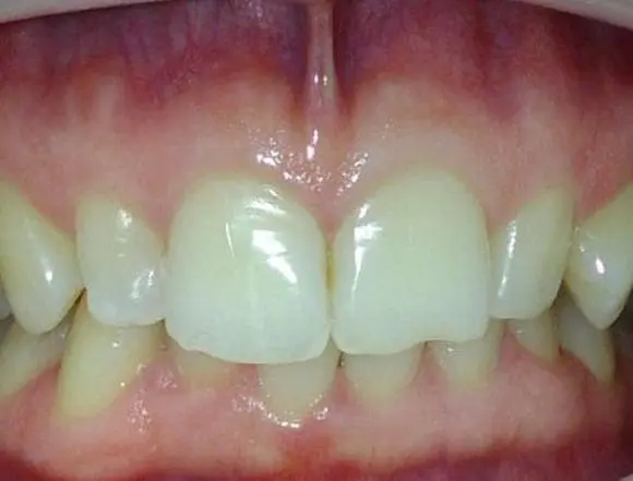 Invisalign
