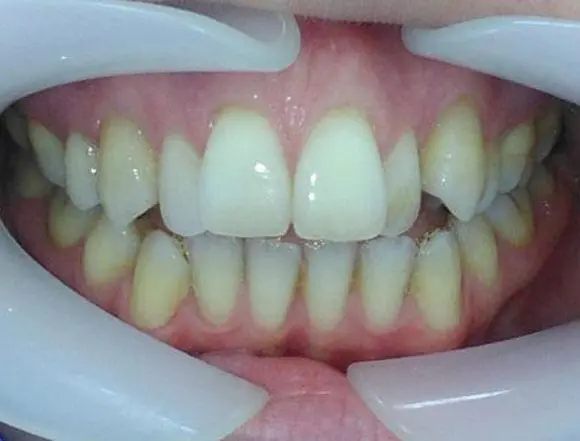 Invisalign