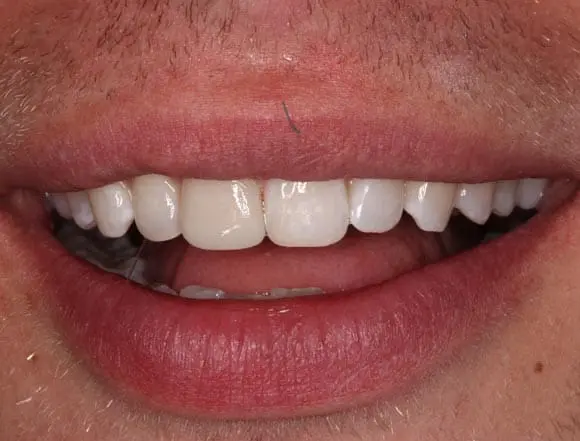 Whitening & Composite Bonding