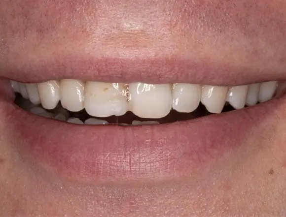 Whitening & Composite Bonding