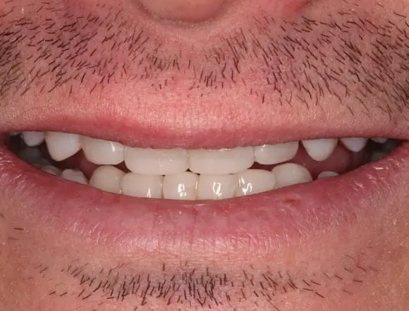 Whitening & Composite Bonding