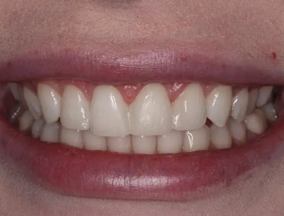 Whitening & Composite Bonding