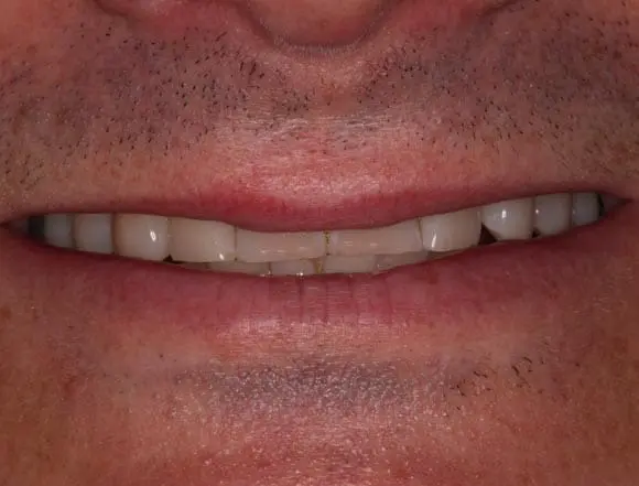 Whitening & Composite Bonding