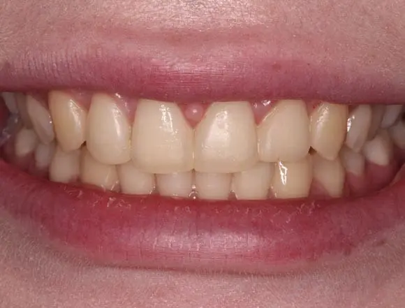 Whitening & Composite Bonding
