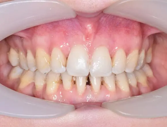 fixed braces