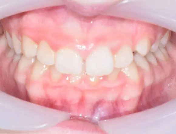 Fixed Braces