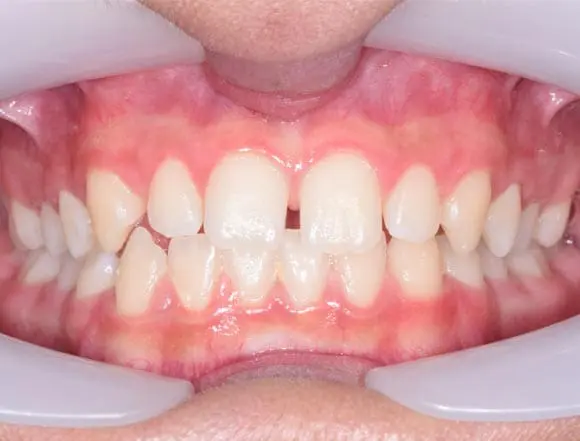Fixed Braces