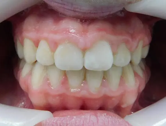 Fixed Braces