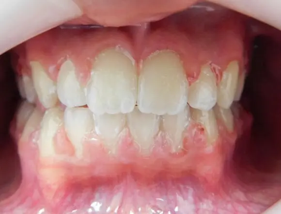 Fixed Braces