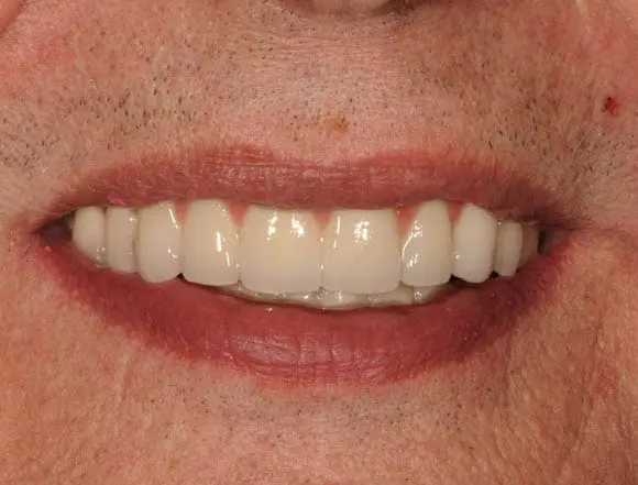 implants