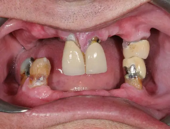 implants