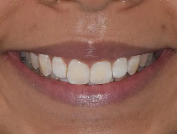 Invisalign