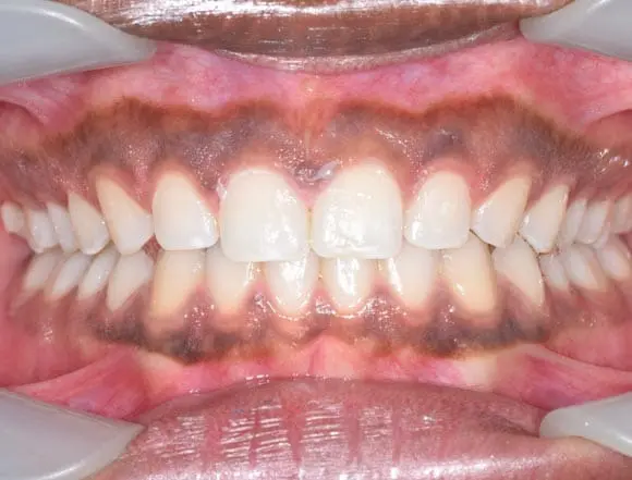 Invisalign