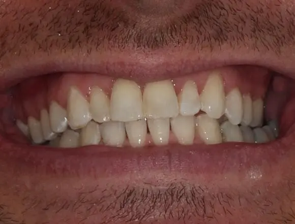 Invisalign