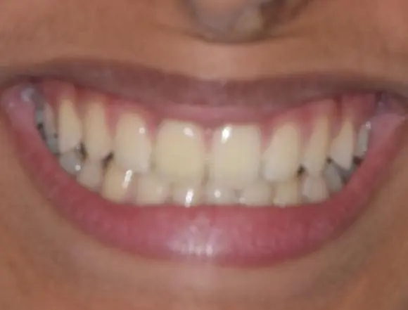 Invisalign