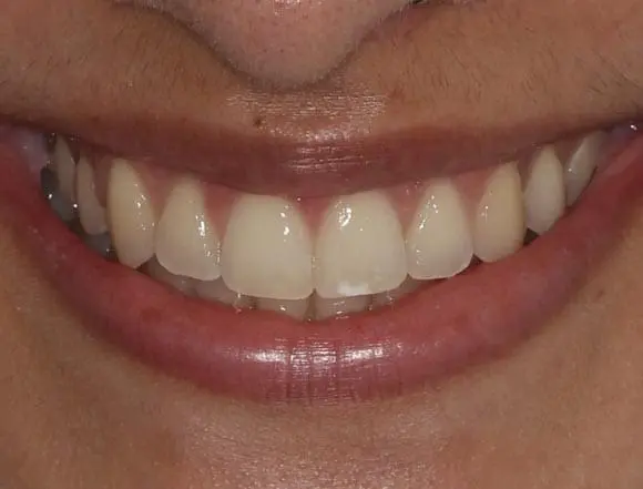 Invisalign