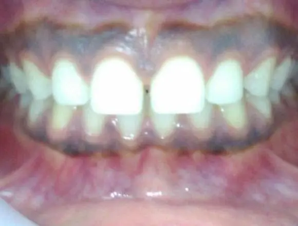 Invisalign