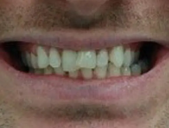 Invisalign