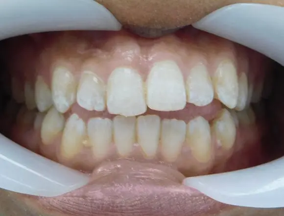 Invisalign